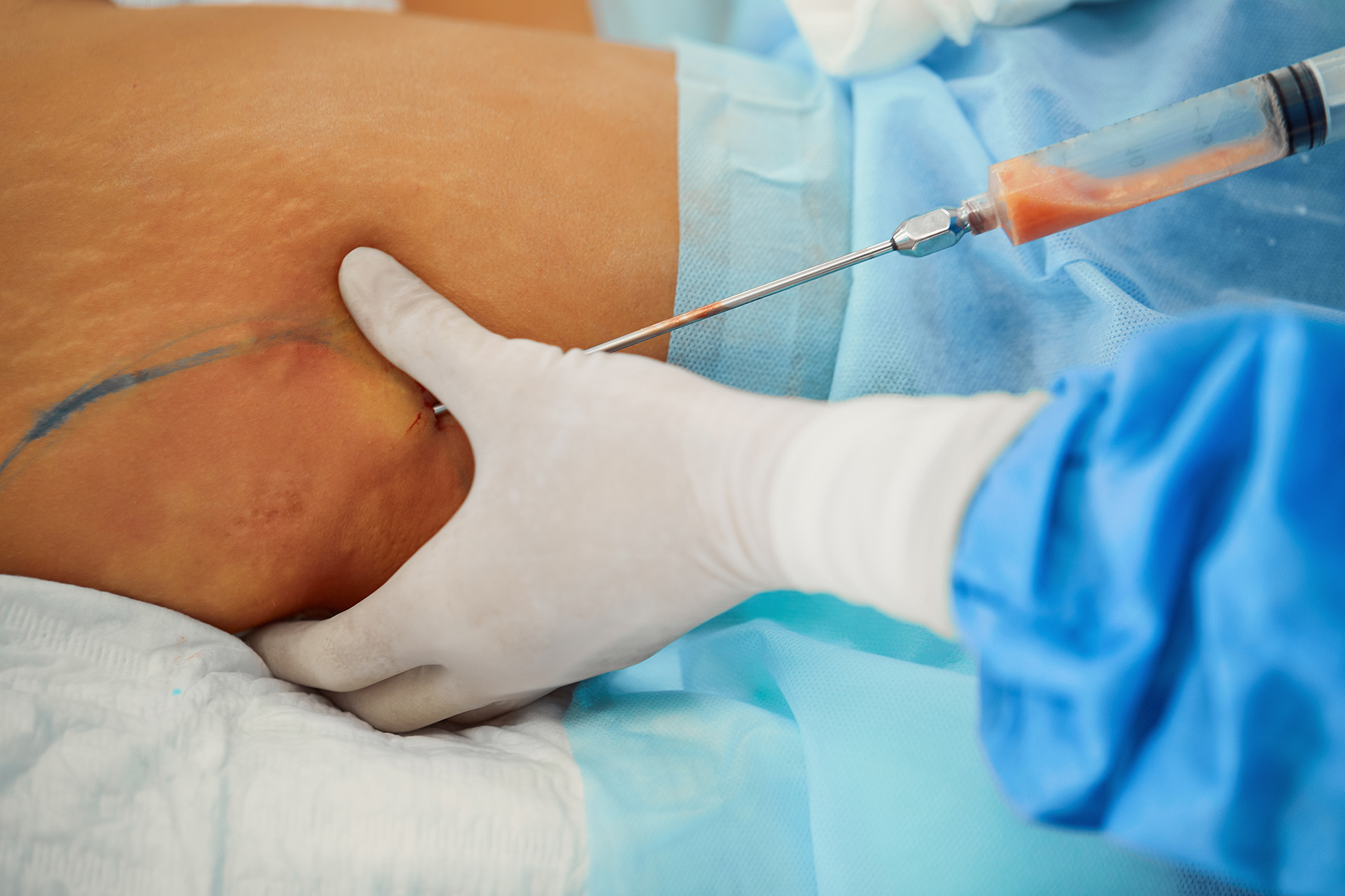 lymphatic drainage massage after liposuction