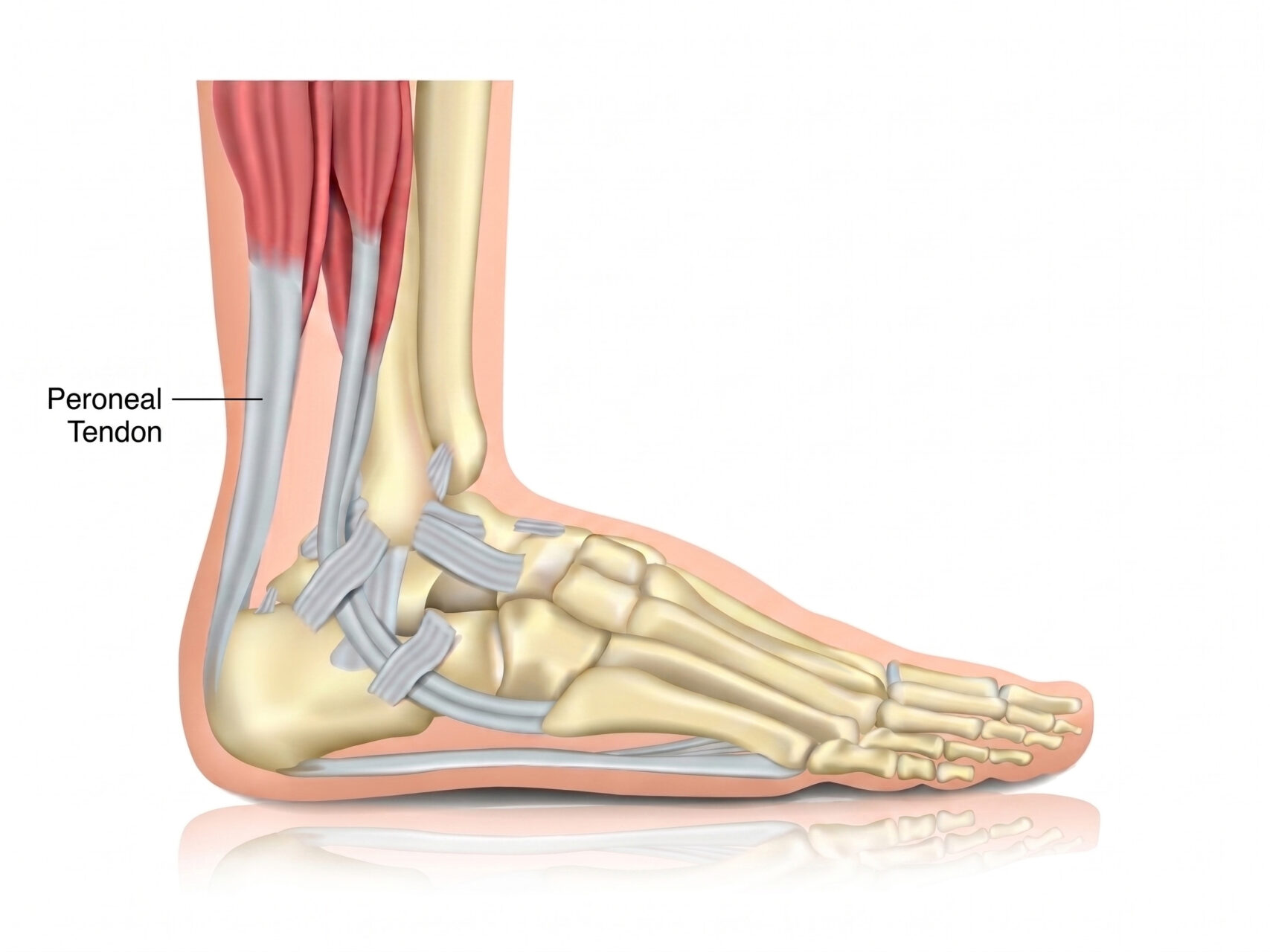 peroneal tendonitis