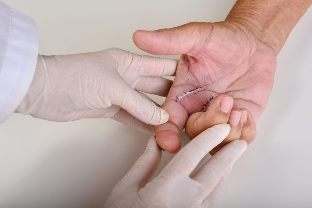trigger finger surgery